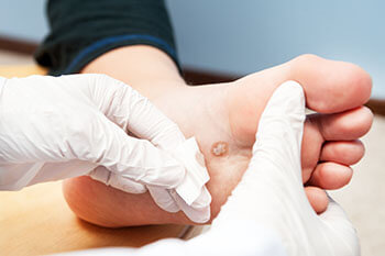 Plantar warts treatment in the Davidson County, TN: Nashville (Belle Meade, Forest Hills, Berry Hill, Oak Hill, Forest Hills, Goodlettsville) and Sumner County, TN: Hendersonville areas