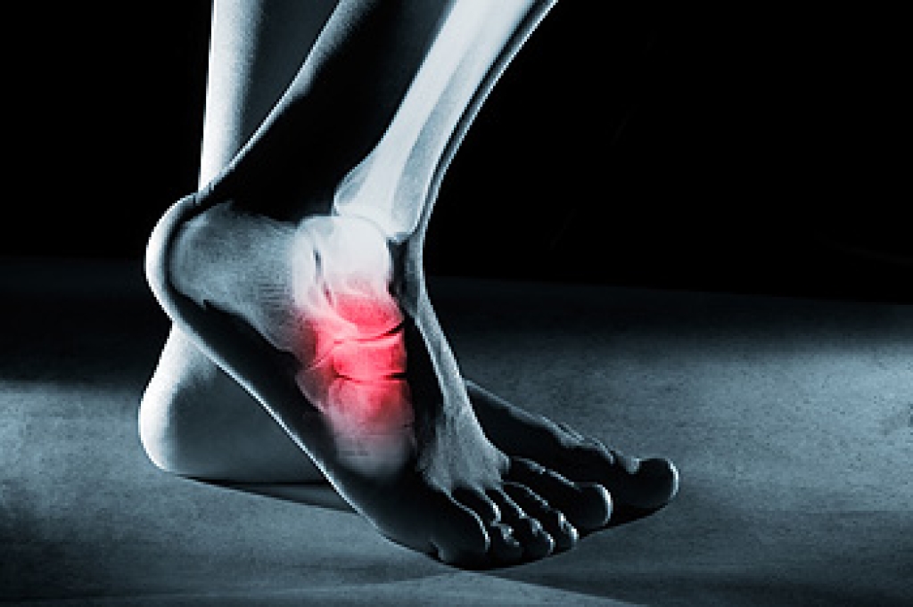 5th Metatarsal Fractures Explained