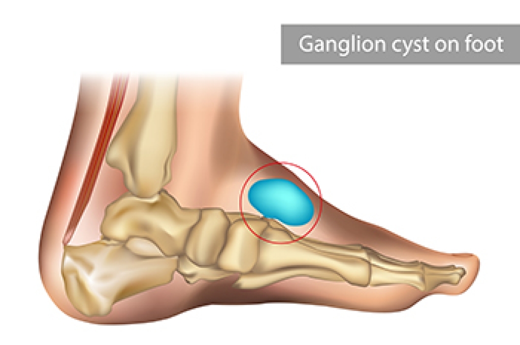 Ganglion Cysts of the Foot