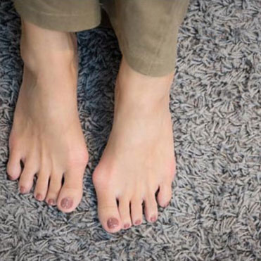 Bunions Treatment in the Davidson County, TN: Nashville (Belle Meade, Forest Hills, Berry Hill, Oak Hill, Forest Hills, Goodlettsville) and Sumner County, TN: Hendersonville areas