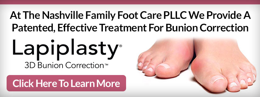 Lapiplasty® 3D Bunion Correction Treatment in the Davidson County, TN: Nashville (Belle Meade, Forest Hills, Berry Hill, Oak Hill, Forest Hills, Goodlettsville) and Sumner County, TN: Hendersonville areas