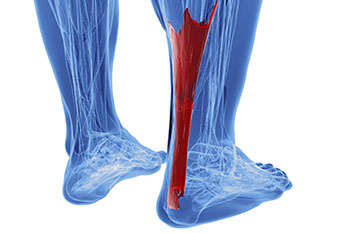 Achilles tendon treatment in the Davidson County, TN: Nashville (Belle Meade, Forest Hills, Berry Hill, Oak Hill, Forest Hills, Goodlettsville) and Sumner County, TN: Hendersonville areas