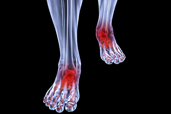 Arthritic foot care in the Davidson County, TN: Nashville (Belle Meade, Forest Hills, Berry Hill, Oak Hill, Forest Hills, Goodlettsville) and Sumner County, TN: Hendersonville areas