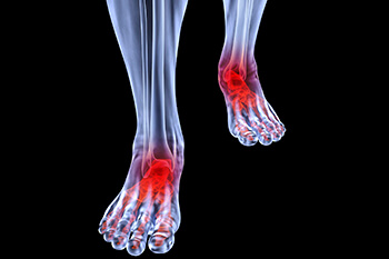 Arthritic foot care in the Davidson County, TN: Nashville (Belle Meade, Forest Hills, Berry Hill, Oak Hill, Forest Hills, Goodlettsville) and Sumner County, TN: Hendersonville areas