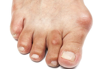 Bunions treatment in the Davidson County, TN: Nashville (Belle Meade, Forest Hills, Berry Hill, Oak Hill, Forest Hills, Goodlettsville) and Sumner County, TN: Hendersonville areas