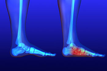 Flat feet treatment in the Davidson County, TN: Nashville (Belle Meade, Forest Hills, Berry Hill, Oak Hill, Forest Hills, Goodlettsville) and Sumner County, TN: Hendersonville areas