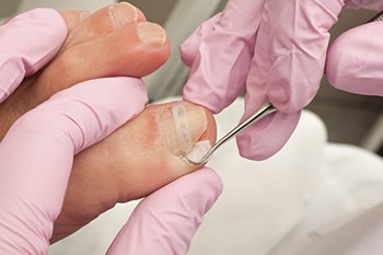 Ingrown toenail treatment in the Davidson County, TN: Nashville (Belle Meade, Forest Hills, Berry Hill, Oak Hill, Forest Hills, Goodlettsville) and Sumner County, TN: Hendersonville areas