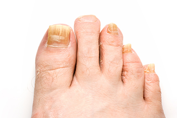 Toenail fungus treatment in the Davidson County, TN: Nashville (Belle Meade, Forest Hills, Berry Hill, Oak Hill, Forest Hills, Goodlettsville) and Sumner County, TN: Hendersonville areas