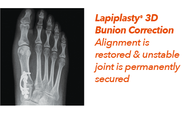 Lapiplasty® 3D Bunion Correction in the Davidson County, TN: Nashville (Belle Meade, Forest Hills, Berry Hill, Oak Hill, Forest Hills, Goodlettsville) and Sumner County, TN: Hendersonville areas