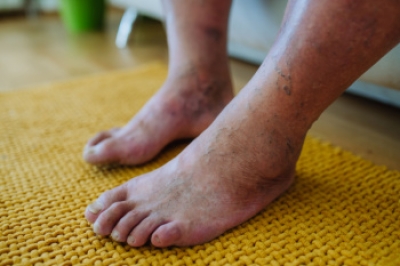How Confidence Affects Diabetic Foot Care
