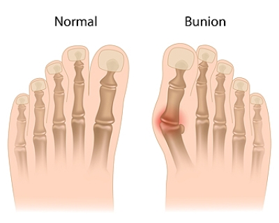 Bunions and Their Causes