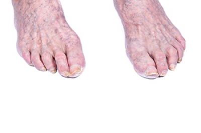 The Characteristics of Elderly Feet