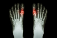 A Guide to Diagnosing Gout