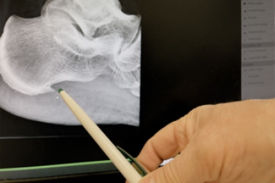 Key Facts About Heel Spurs