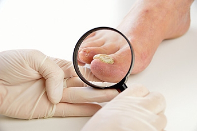 Symptoms and Risk Factors for Fungal Toenails